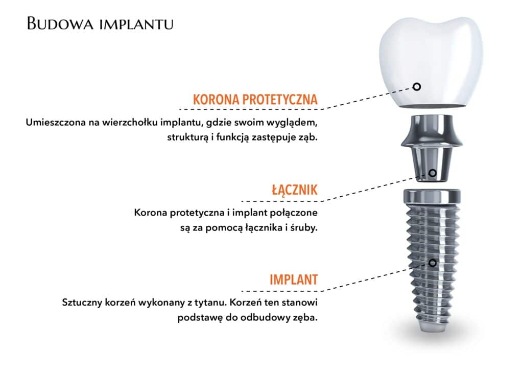 Implant Poznań - budowa